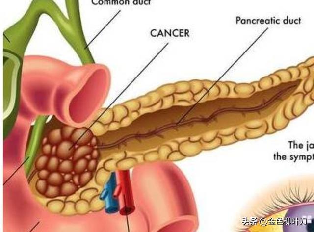 胰腺癌一般哪里会出现疼痛？