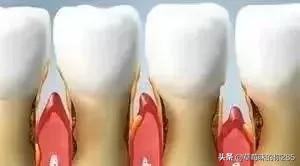 牙龈萎缩很严重怎么办？