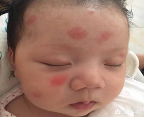宝宝被蚊子咬了好几个大包，晚上很痒，怎么消肿止痒？