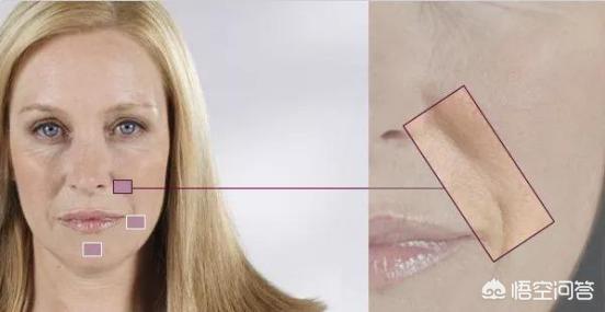 如何改善脸部的下垂和法令纹？