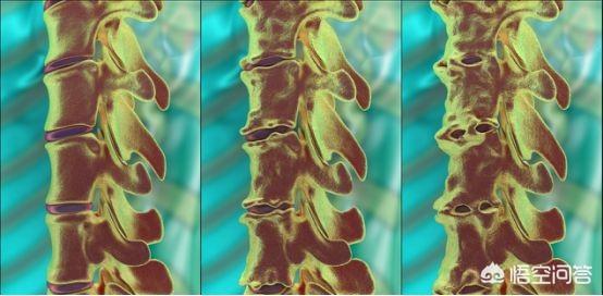 强制性脊柱炎患者应该怎样治疗和保养？