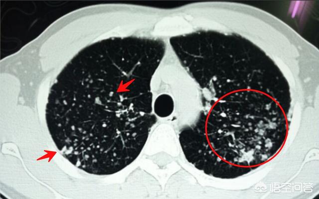 什么情况会造成肺结节？
