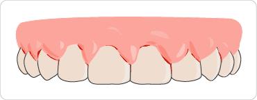 去牙医那边洗完牙之后，牙龈经常出血是怎么回事呢？