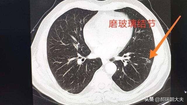 肺结节是什么？今天检查后，是肺结节怎么办？