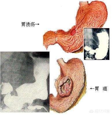 胃炎和胃癌该怎样区分（胃癌与胃炎怎样区分）