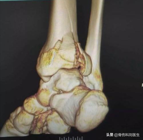 脚踝关节处骨折上钢板手术后怎样正确恢复？