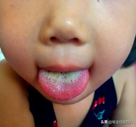 孩子“口气大”，舌苔发白，刷牙有用吗？是什么地方出问题了？